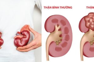 hội chứng thận hư