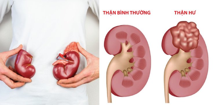 Hội chứng thận hư